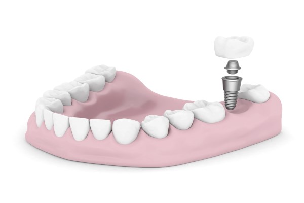 How A Surgical Dental Implant Fuses With  Jawbone