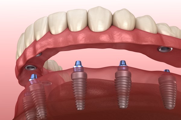 Comparing Implant Supported Dentures With Traditional Dentures